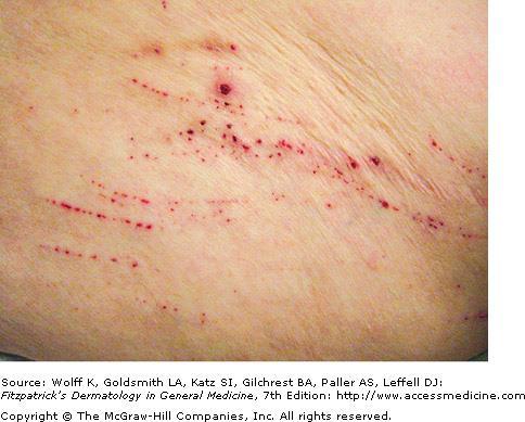 Excoriations Superficial excavations of epidermis result from