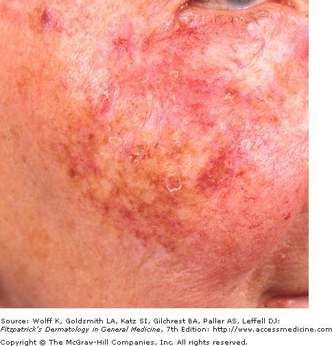Poikiloderma Refers to the combination of Atrophy Telangiectasia Pigmentary changes (hyper- and hypo-).