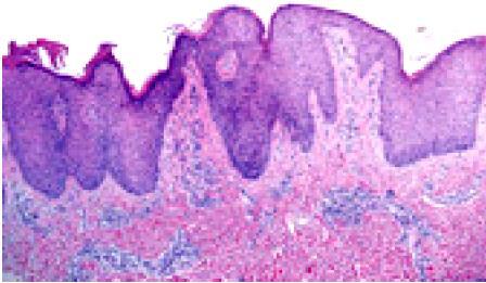 Acanthosis Atrophy http://www.