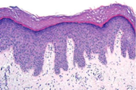 Hyperkeratosis Thickening of the stratum corneum associated with a qualitative abnormality of the keratin