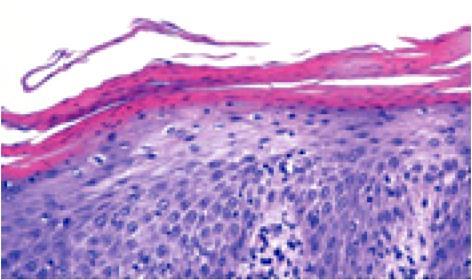 Parakeratosis Caused by incomplete keratinization nuclei remain in the cells of the horny cell layer such as