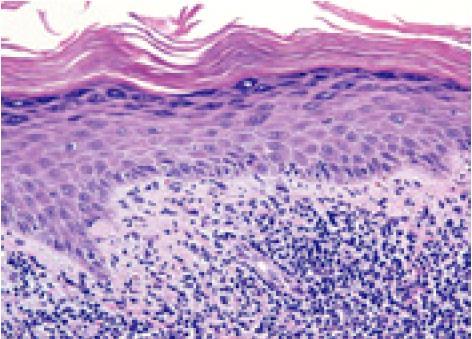 Hypergranulosis A thickening of the granular cell layers to > 4 layers (normal 1-3) It is often