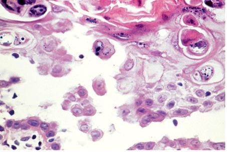 Dyskeratosis Abnormal keratinization occurring prematurely within individual cells below the