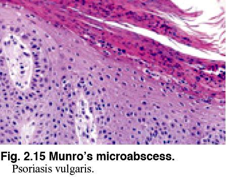 Munro s microabcess A blister containing purulent (mainly neutrophils) A small pustule