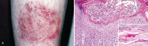 Tinea Corporis Tinea A : well circumscribed erythematous macule, papule to plaque with active border and central regression B : mild spongiosis and focal neutrophilic abscesses with fungal hyphae C