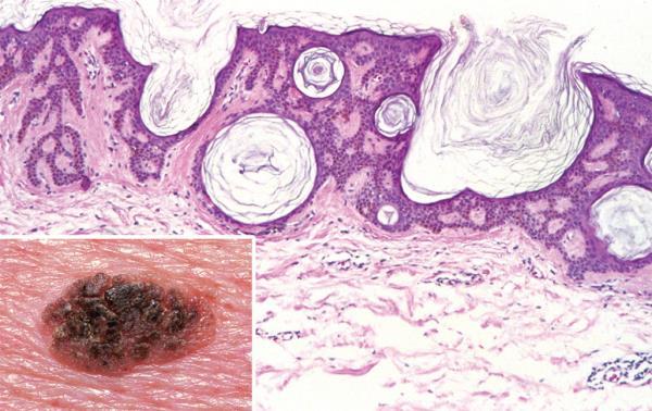 Seborrheic keratosis A well-demarcated coin like pigmented lesion with warty surface stuck on