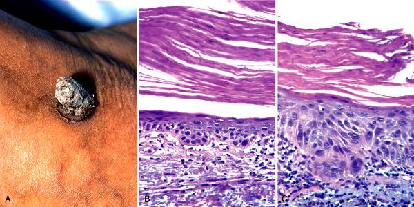 Actinic Keratosis Hypertrophic Actinic keratosis A : A cutaneous horn horn like projection keratin B : Basal cell layer atypia (dysplasia) is associated with marked hyperkeratosis and parakeratosis C