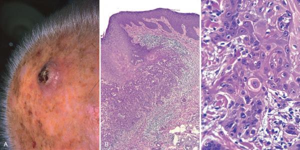 Squamous Cell Carcinoma Invasive squamous cell carcinoma A: Lesions are often nodular and ulcerated as seen in this scalp tumor.