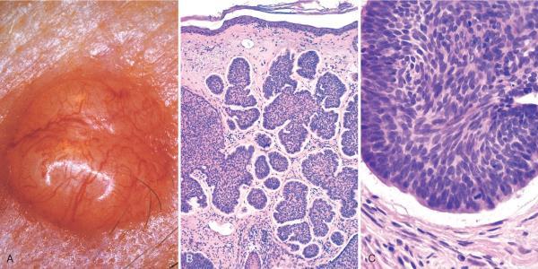Basal Cell Carcinoma Basal cell carcinoma A : Pearly, telangiectatic nodules B : Nests