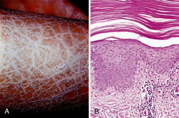 Ichthyosis prominent fishlike scales compacted, thickened stratum corneum - Group of genetically inherited