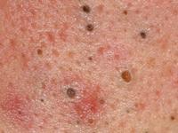 Acne Divided into 2 types Non inflammatory types Open comedones : black