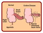 especially the lower part of the small intestines and the colon Inflammation can occur between health sections of the gut and can penetrate the gut lining.