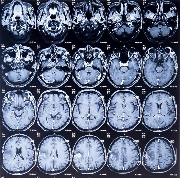 Figure: An MRI scan showing images of the brain You might have an MRI scan to: diagnose and assess lymphomas of the central nervous system (brain and spinal cord) or the