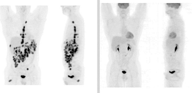 Figure Left: Non-Hodgkin lymphoma stage IV.