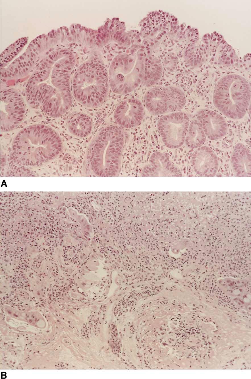 AJG January, 2002 Are Ulcers a Marker for Invasive Carcinoma in Barrett s? 29 Figure 2. Nonulcerated area (A) and ulcerated one (B) in specimen submitted as HGD.
