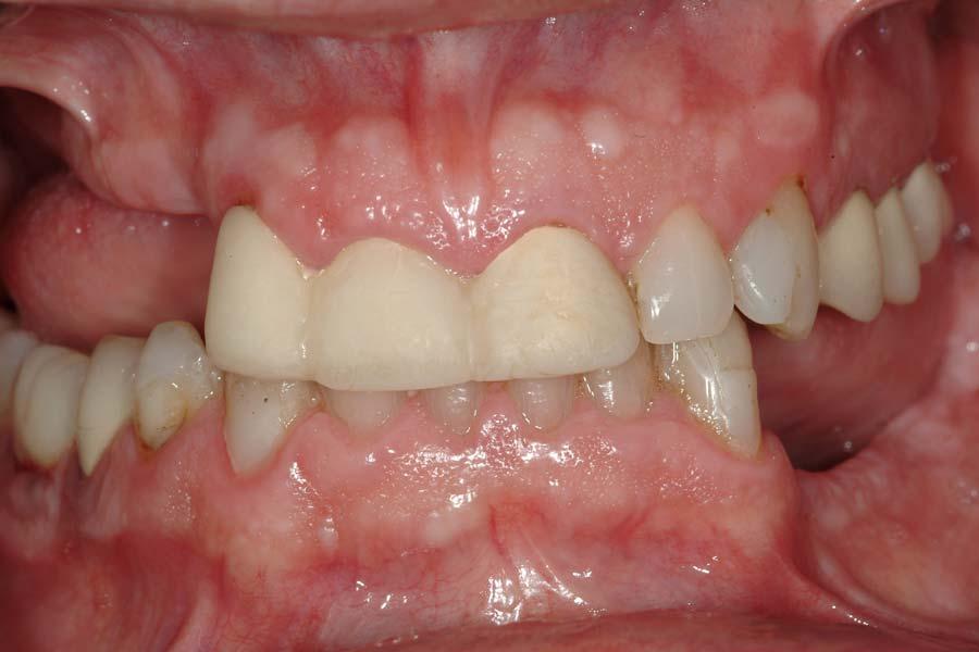 This patient presented with missing teeth in the upper right and lower sections of his mouth as a result of an accident.