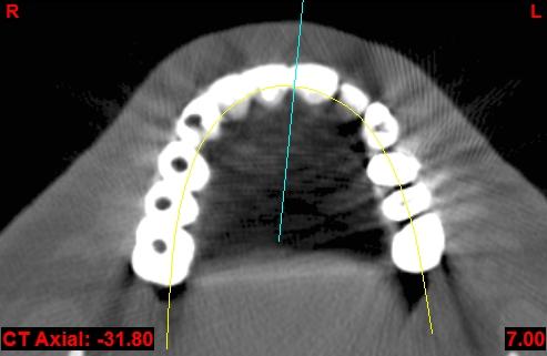 The Diagnostic Phase of Implant Care CT Scan Assessment and 3D planning The picture above represents an axial view of this patients maxillary arch where he is hoping to have dental implants placed to