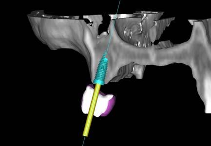 of implant position Analysis of implant