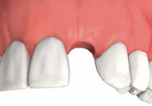 single tooth replacement A missing tooth can be replaced by a dental implant without altering the healthy adjacent teeth.
