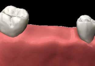 multiple teeth replacement If you are missing more than one tooth, dental