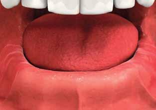 implant-stabilized denture If all your lower teeth are missing, another option may be to stabilize your removable denture using a small number of implants.