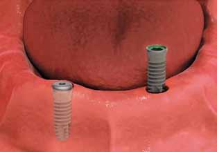 two or more implants are placed