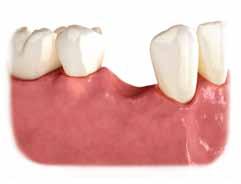 cavities and tooth failure dental implants with