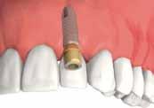 implants with dentures