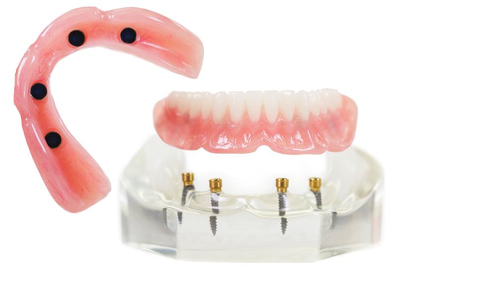 Rather than using metal clasps or natural suction to stay in place, it relies on multiple dental implants placed directly into the jawbone.