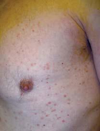 Illustrated quizzes on problems seen in everyday practice CASE 1 A 66-year-old male presents with ruddy-brown, pruritic papules on his chest and back that have been present for several years.