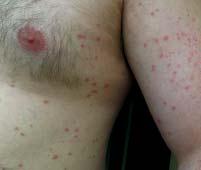 CASE 2 A 29-year-old gardener develops an acute onset of scaly, erythematous papules on his trunk and proximal limbs. He reports having felt unwell prior to the rash developing. 2. Is there any association with this condition?
