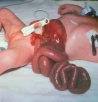 CASE 3 This infant is born to a G2P1, 24-year-old mother by cesarean section at 35 weeks gestation. At birth, loops of small bowels are found protruding from the abdominal cavity. 2. What is the significance?