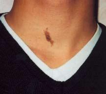 CASE 5 A 16-year-old male presents with a linear, brown, warty lesion on his neck that has been present since birth. There are no other developmental anomalies. 2. What is the significance? 1. Linear epidermal nevus.