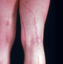 CASE 8 A 10-year-old male presents with an asymptomatic, linear eruption spreading down the inner thighs of his leg that has been present for four months. 2. What is the differential diagnosis? 1. Lichen striatus.