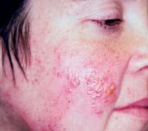 CASE 9 A 26-year-old female presents with an itchy rash on the right side of her face, consisting of weeping blisters grouped in a linear fashion. 2. What is the treatment? 1.