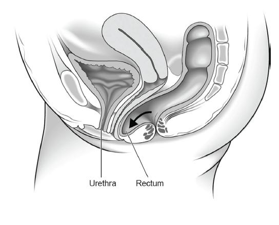 Page 4 of 11 Posterior wall prolapse (rectocele) when the rectum bulges into the back wall of the vagina. Uterine prolapse when the uterus hangs down into the vagina.