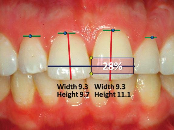 embrasure. FIGURE 5. The intraoral image demonstrated reasonably well-aligned teeth with good overbite/overjet but with the previously described esthetic shortcomings.