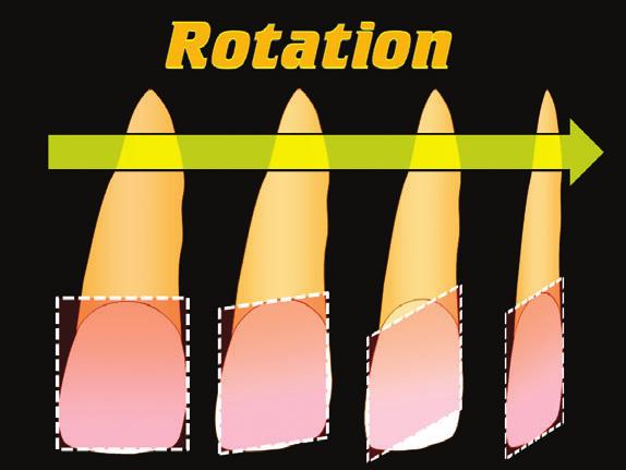 FIGURE 7. The teeth are aligned before tooth reshaping begins. If a tooth is rotated, our perception of its width is changed while the height is not, giving a misleading height/width ratio. FIGURE 8.
