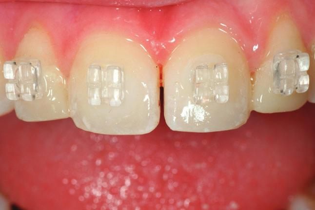 Because the left central incisor was the proper height/width ratio, it was logical that the right central needed to be lengthened, if possible.