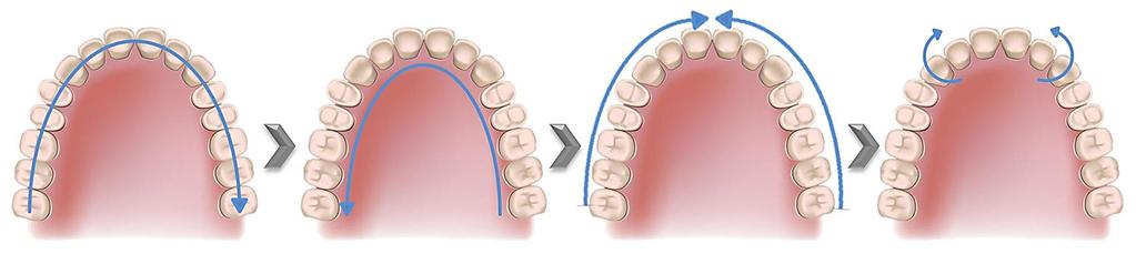 Scanning Bonded Patients If the patient is bonded, add the best practices on the following pages to your procedure to adequately capture teeth with brackets.