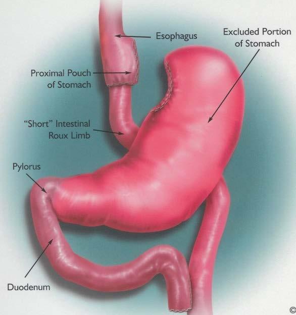 GASTRIC BYPASS RISKS INFECTION BLEEDING LEAKS BLOOD CLOT ULCER