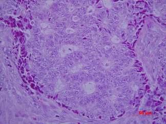 Slika 1. Duktalni invazivni karcinom koji pokazuje stvaranje žljezdanih nakupina, stanice koje ih formiraju karakterizirane su grubim kromatinom i uočljivim nukleolima.