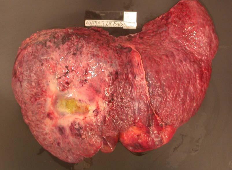 Hepatocellular Carcinoma Accounts for 50% of LT Many dropouts on the waiting list Medical therapy ineffective Locoregional therapy infrequently curative Radiofrequency ablation