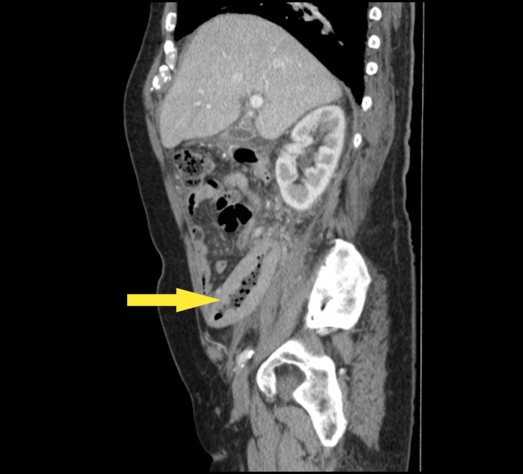 Fig. 8: Sagittal CT slice illustrating mural thickening in a segment of ileum.
