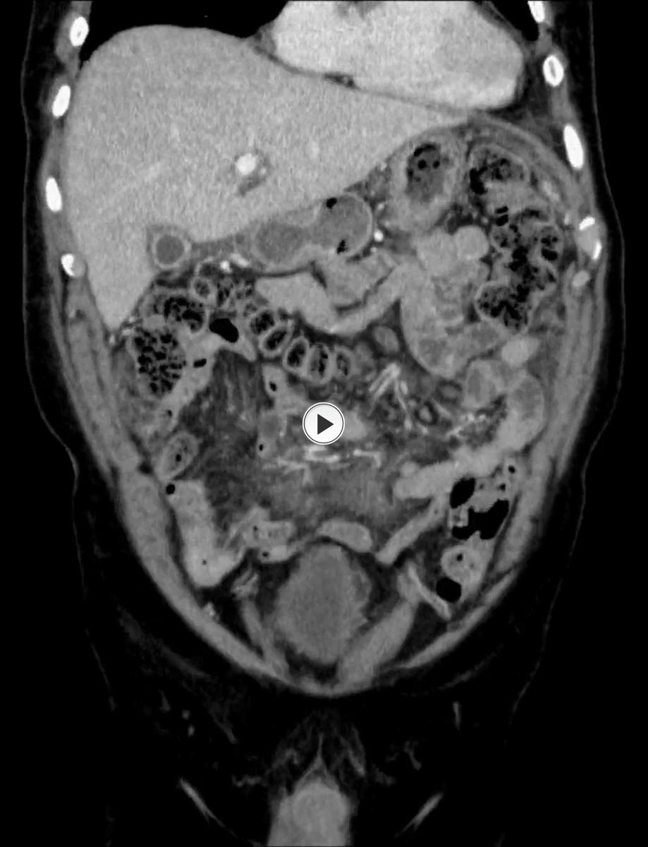 Fig. 10: Cine loop of coronal CT slices illustrating