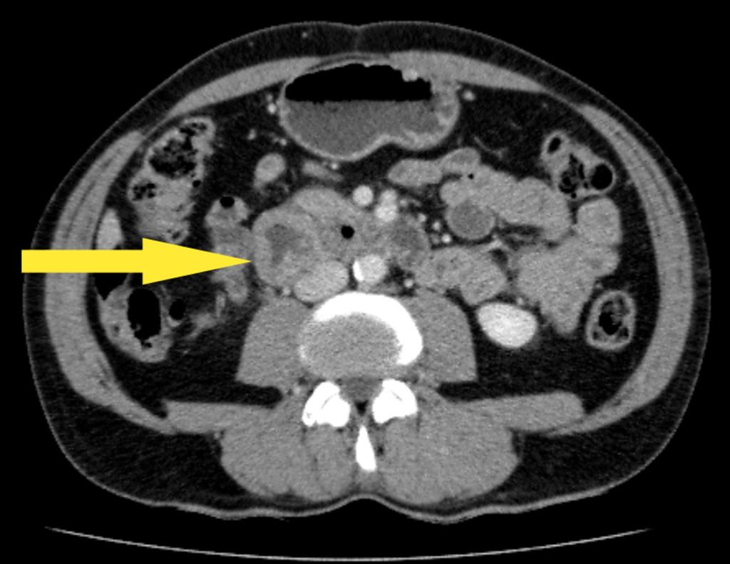 Fig. 12: Axial CT slice illustrating mural thickening in a segment of duodenum