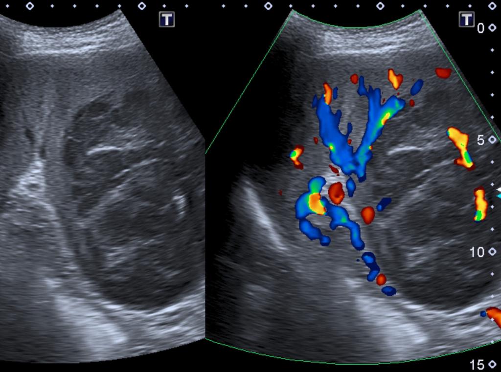 Fig. 14: Ultrasound image of the spleen showing splenomegaly with multiple hypoechoic