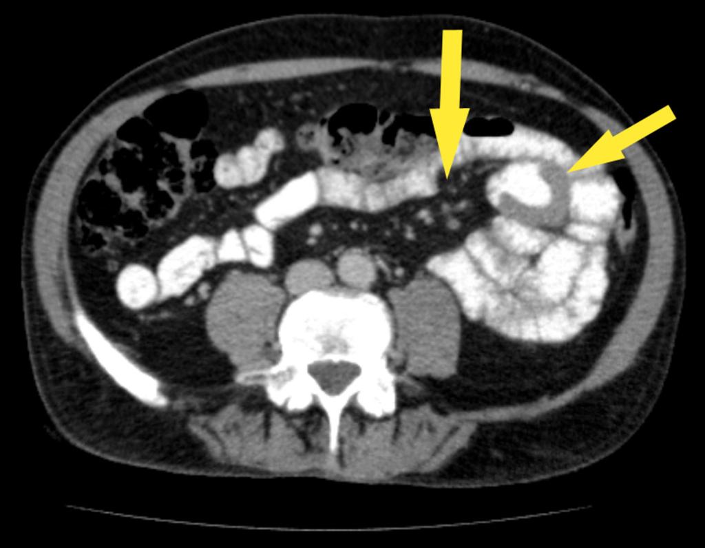 Fig. 15: Sagittal CT slice illustrating splenomegaly with multiple low attenuating regions, and a segment of small bowel with mural thickening.