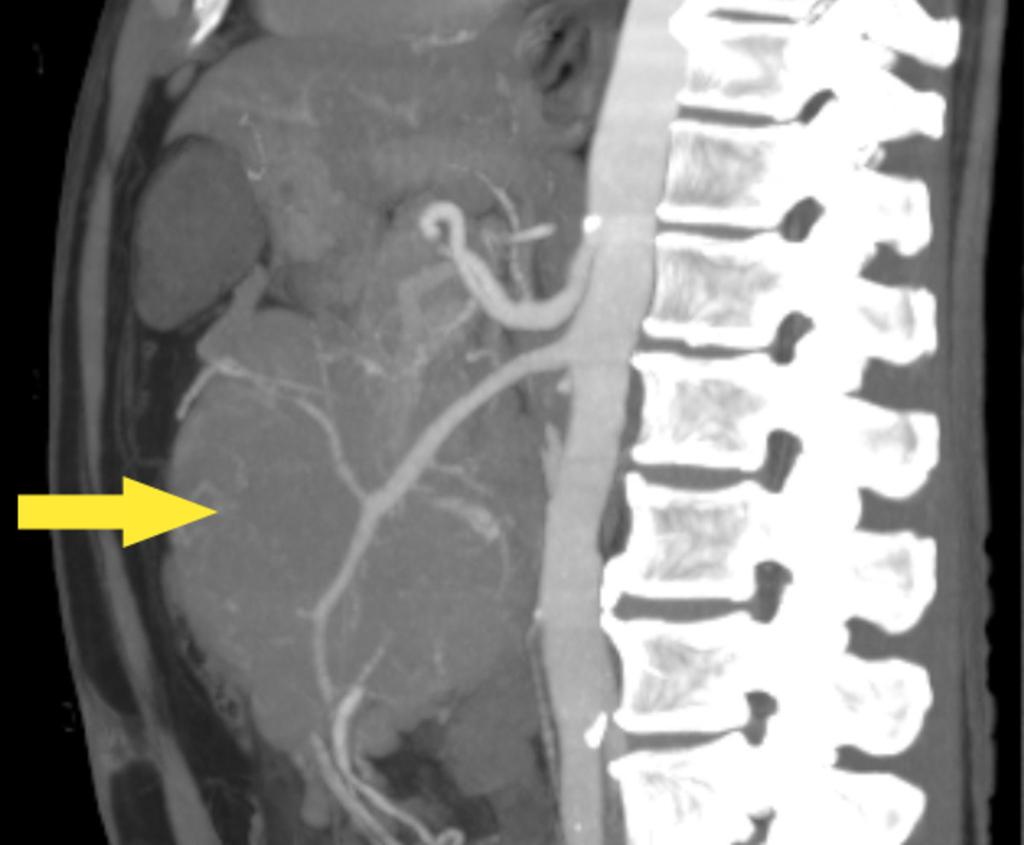 Fig. 17: Sagittal CT slice using maximum intensity projection (MIP) to illustrate a mesenteric mass abutting the small bowel, and