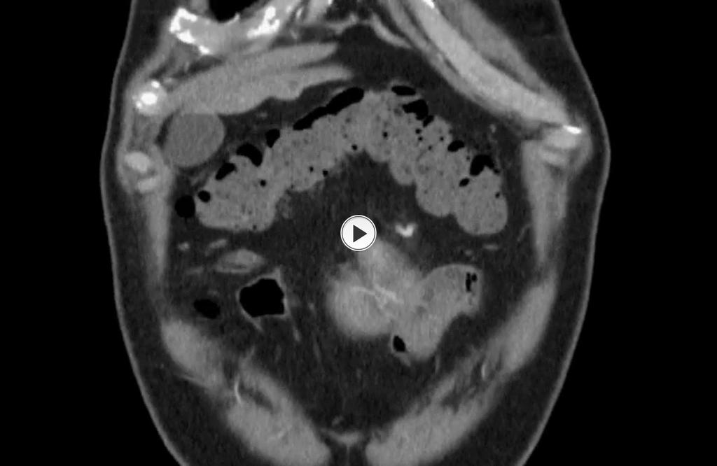 Fig. 18: Cine loop of coronal CT slices illustrating a mesenteric mass abutting the small bowel, and encasing the superior mesenteric artery.